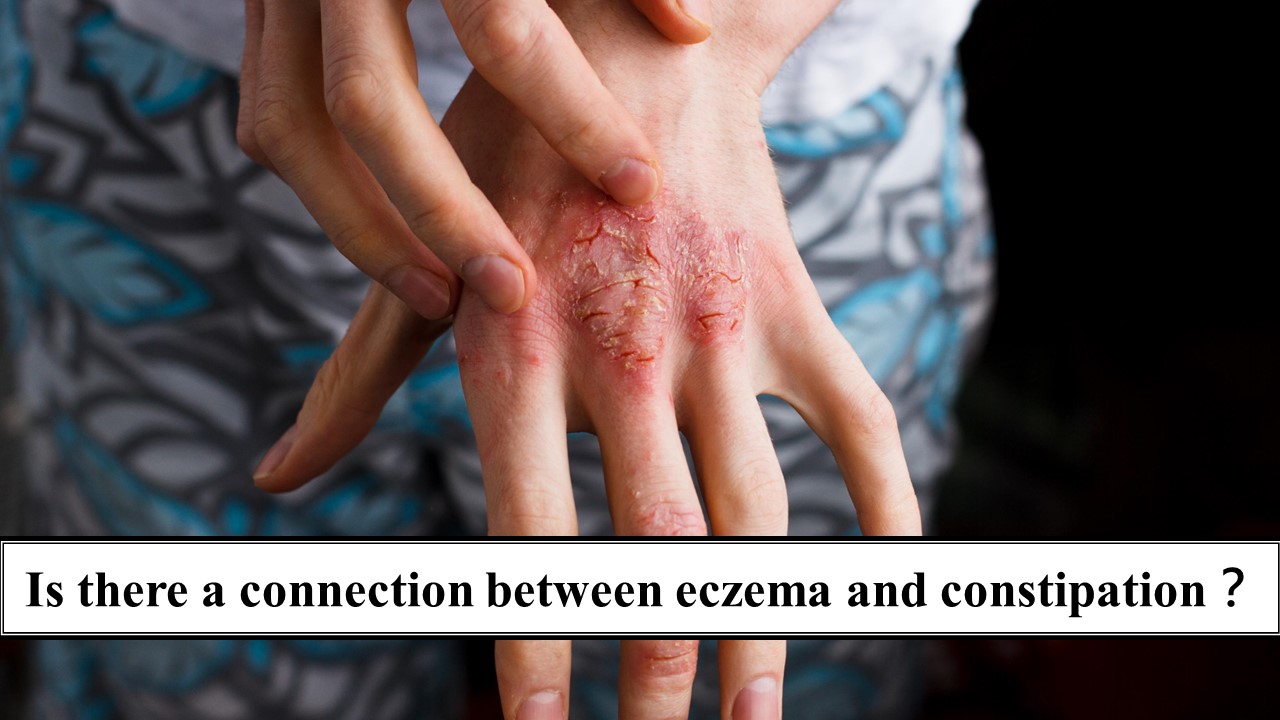 141_Is there a connection between eczema and constipation？