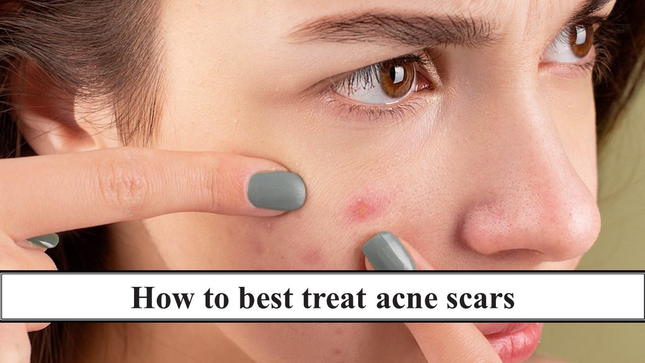 145_How to best treat acne scars